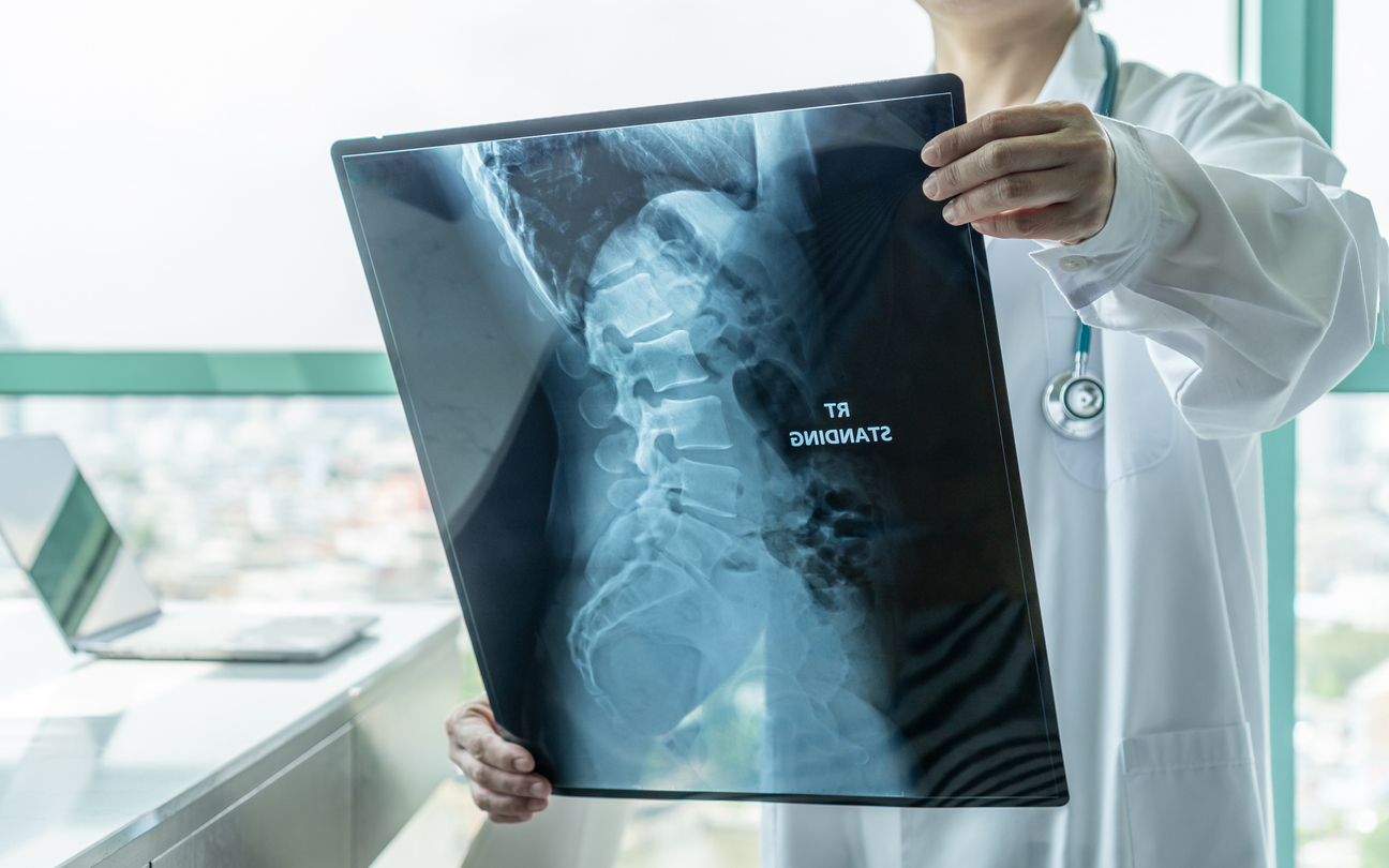 Herniated Disc From a Car Accident Settlement in Georgia