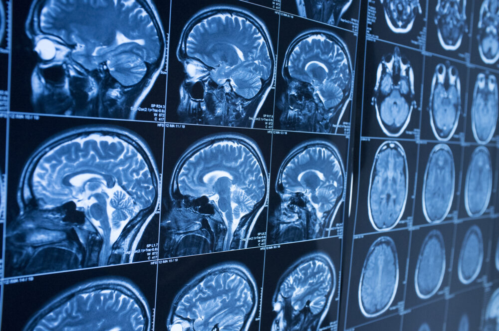 Average Settlement for Traumatic Brain Injury in Georgia