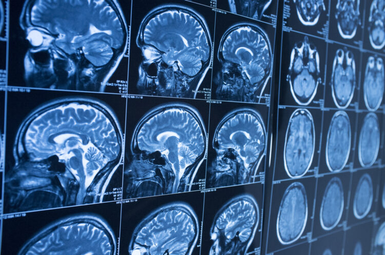 What Is My Brain Injury Case Worth?
